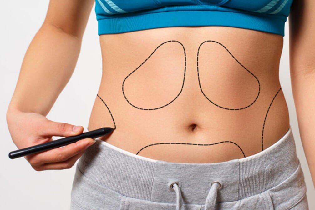 Avail amazing benefits from liposuction and tummy tucker surgeries